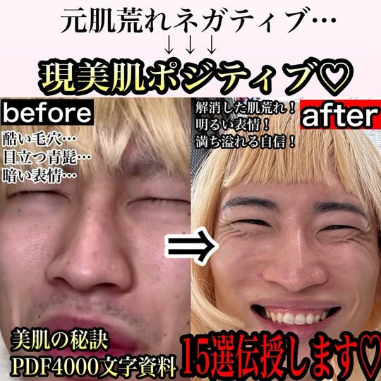 元肌荒れ人生絶望おジャス様が実践してる美肌の秘訣を4000文字資料で教えます♪